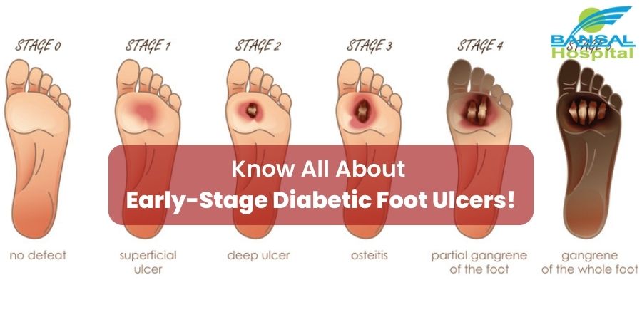 diabetic foot ulcer early signs